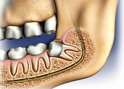 removing-wisdom-teeth-lexu-patna-dental