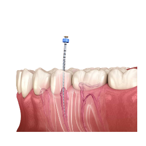 RCT( Root Canal Treatment ) )