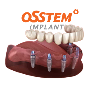 Dental Implant